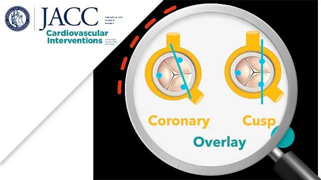 Cusp symmetry and coronary ostial eccentricity and its impact on coronary access following TAVR