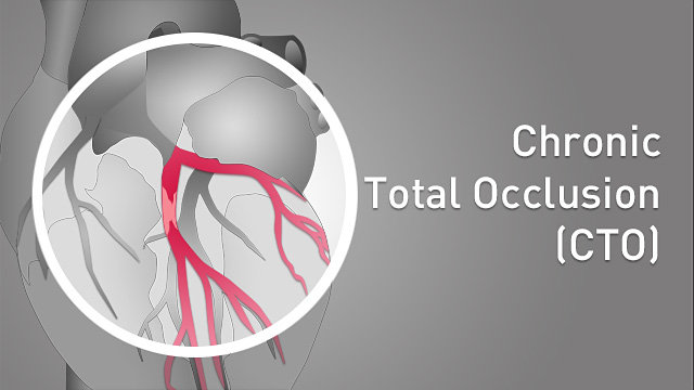 Chronic total occlusion (CTO)