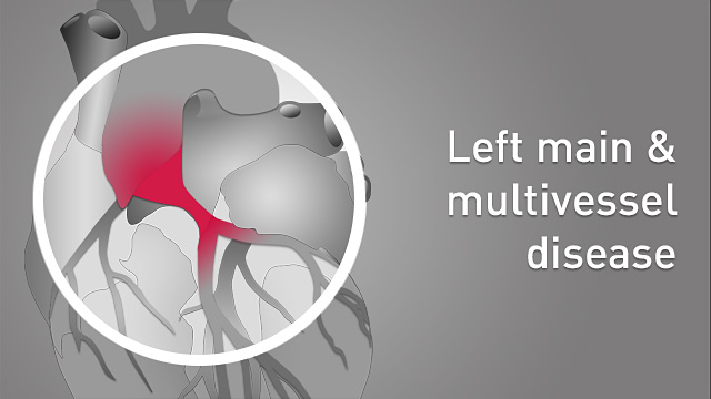 Left main and multivessel disease