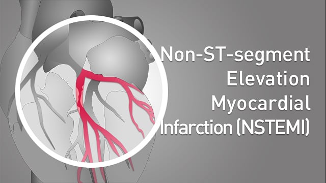 Non-ST-segment elevation myocardial infarction (NSTEMI)