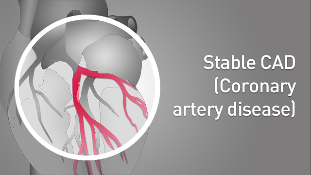 Stable Coronary Artery Disease (Stable CAD)