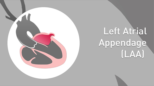 LAA (Left Atrial Appendage) closure