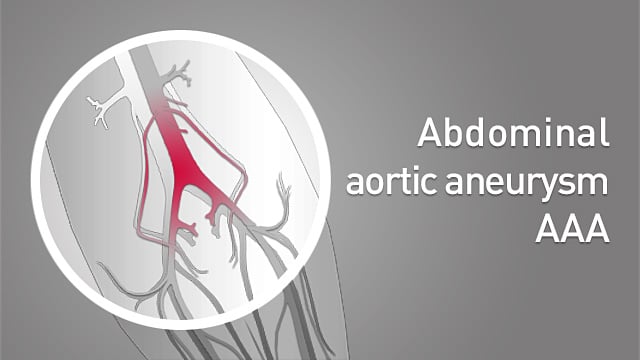 AAA (Abdominal aortic aneurysm)