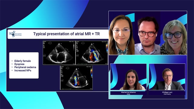 Atrial mitral and tricuspid regurgitation