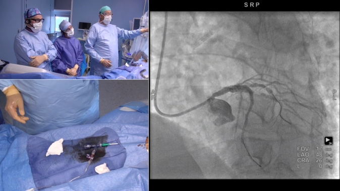 Management of a high bleeding risk (HBR) patient with a bifurcation lesion