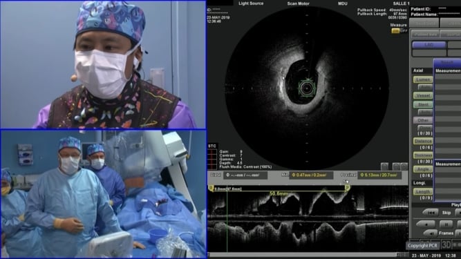 How should I treat a patient at high-bleeding risk requiring complex PCI?  