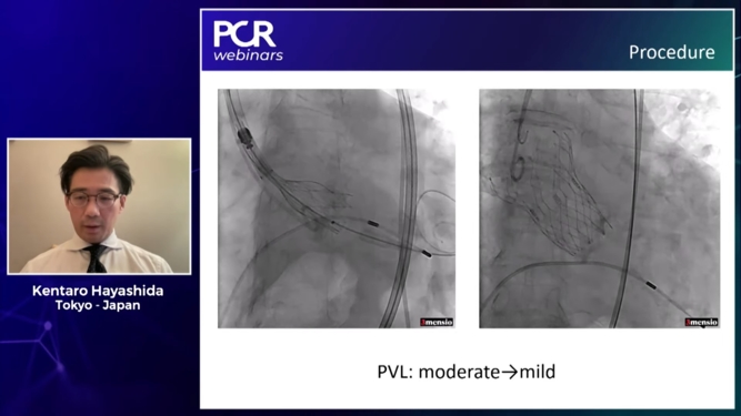 TAVI limiting the risks: Patient & Mismatch