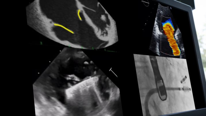 How to identify patients for tricuspid interventions