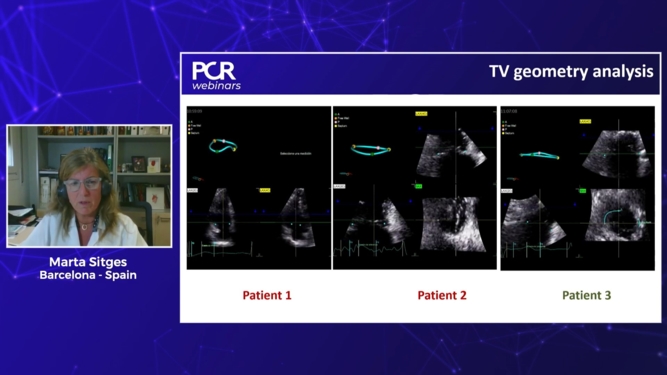 Imaging essentials in atrial functional tricuspid regurgitation