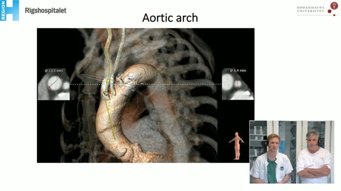 How can I minimise paravalvular leak for my TAVI patients?