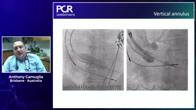 How should I reduce paravalvular leak for my TAVI patients?