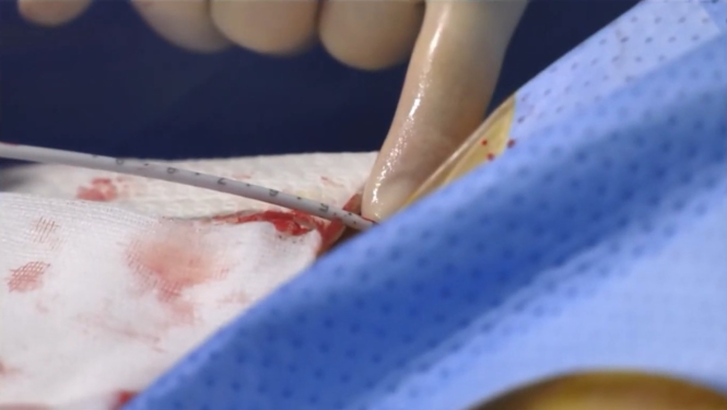 How should I treat asymptomatic CAD patients with an indications for TAVI?