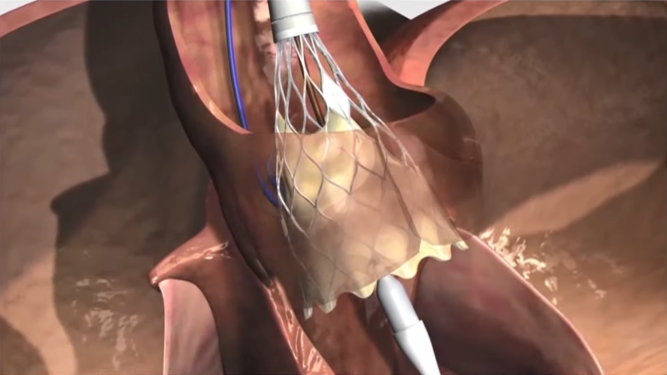 How can we optimise coronary access after TAVI?
