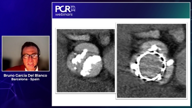 TAVI in bicuspid aortic valve patients: SAPIEN 3 platform, a safe and efficient option