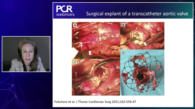 How should the Heart Teams adapt to recently updated Valvular Heart Disease Guidelines?