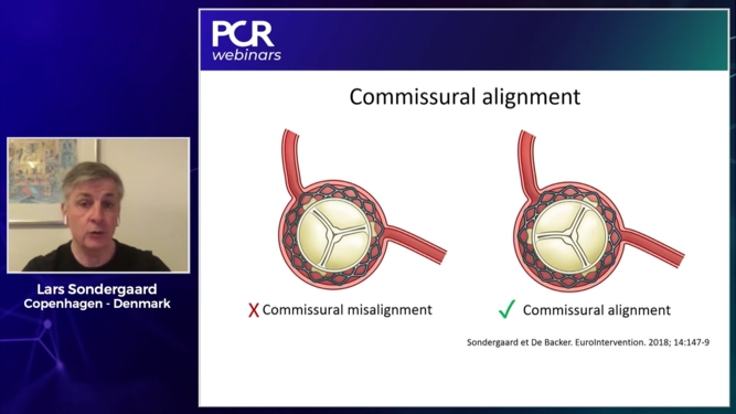 How should I reflect on the lifetime management of my patient since the 1st TAVI procedure?