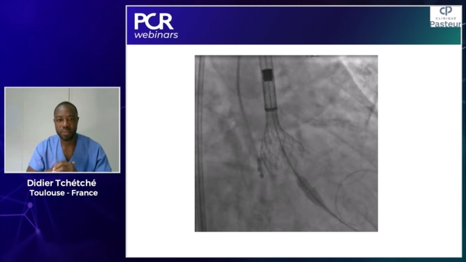 How should I manage complex anatomical situations during my TAVI procedures?