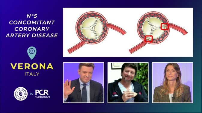 A patient with severe aortic stenosis – how should I treat concomitant coronary artery disease?