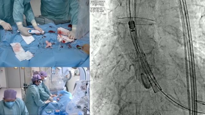The importance of hemodynamic and valve durability in life-time management of patients with aortic stenosis