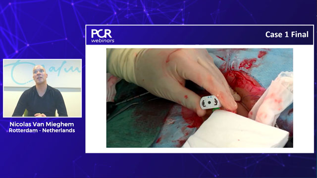 Optimising procedural outcomes of TAVI in challenging anatomies