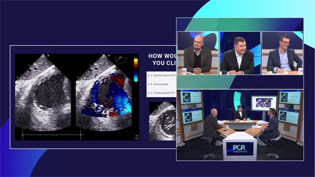 TTVR: will the current guidelines change our work in treating patients with relevant TR?