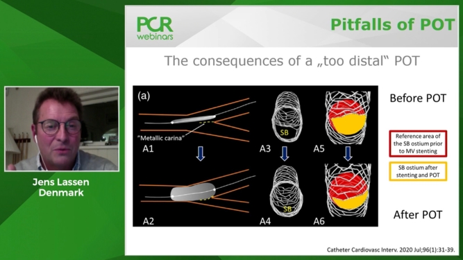 How should I approach bifurcation lesions in my cathlab: stepwise provisional strategy as a treatment philosophy?