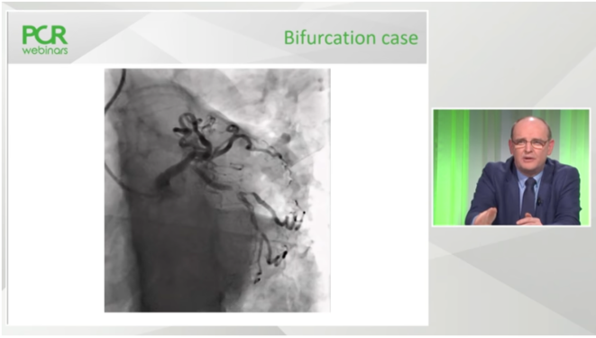 Physiology-guided PCI in bifurcations