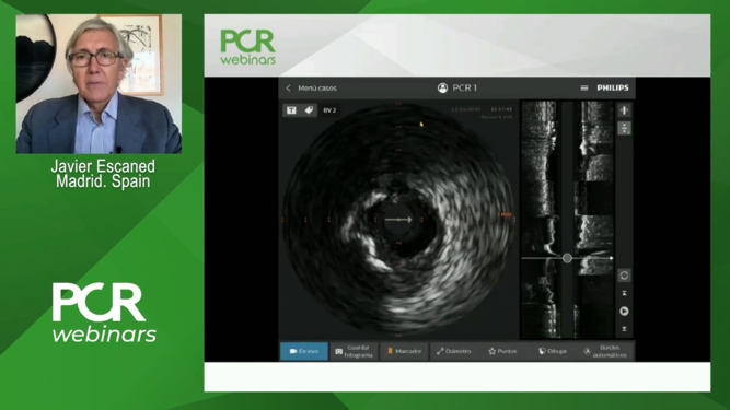 How should I treat a large vessel with massive calcification?