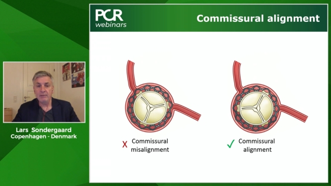 How should I treat calcified lesion involving a bifurcation side branch?