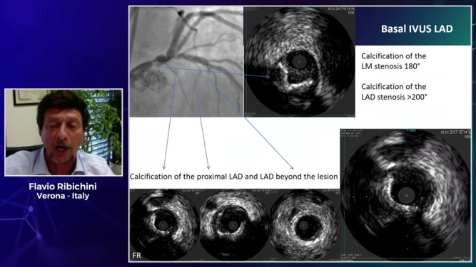 How should I treat calcified lesion involving a bifurcation side branch?