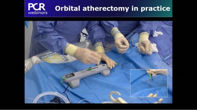 When and how should I treat a calcific coronary stenosis with orbital atherectomy?