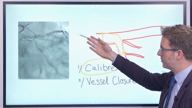 DK Crush for distal LM bifurcation: pearls and pitfalls