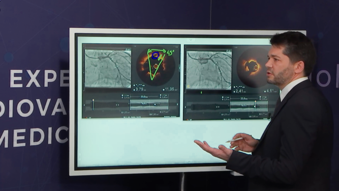 Left main and bifurcation stenting optimised by intracoronary imaging