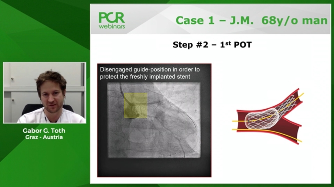 [WATCH] - How should I select and treat a patient with bifurcation lesion needing a two-stent technique?