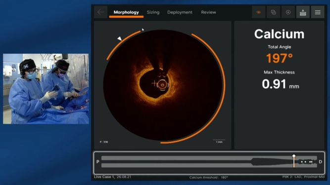 How OCT/XRay imaging workflow can improve your procedure in treating calcified lesions?