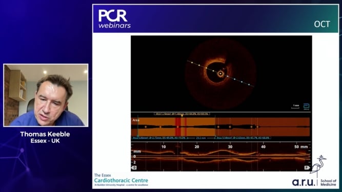 How to use invasive coronary physiology in ACS patients?