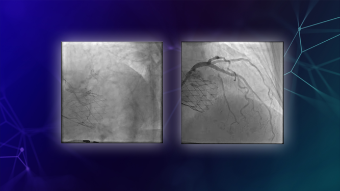 Management of your patients with high bleeding risk – PCI and DAPT strategies