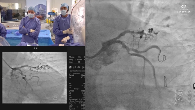 Transradial approach for complex PCI in high bleeding risk (HBR) patient