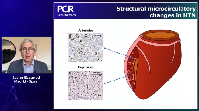 Microcirculatory remodeling cause of INOCA