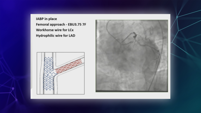 Complex double stent techniques in left main disease