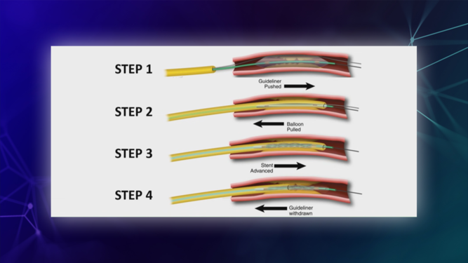PCI of calcified left main – how to do safely?