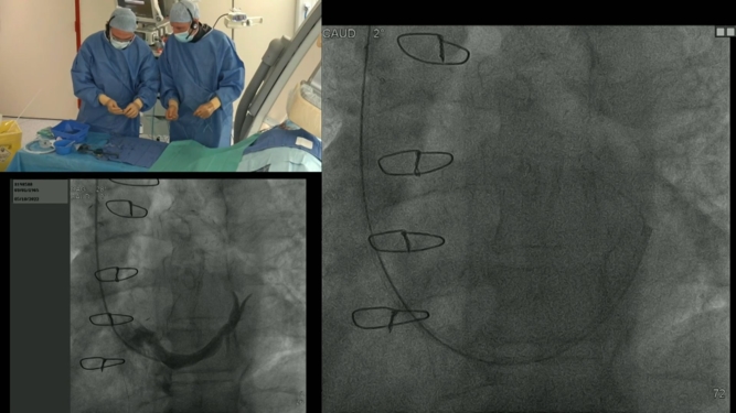 How should I treat patient with refractory angina using the Reducer Device?