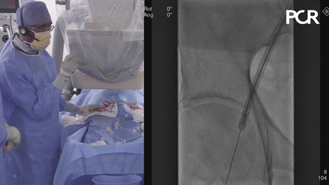 Patient with symptomatic AS using the THV Portico device