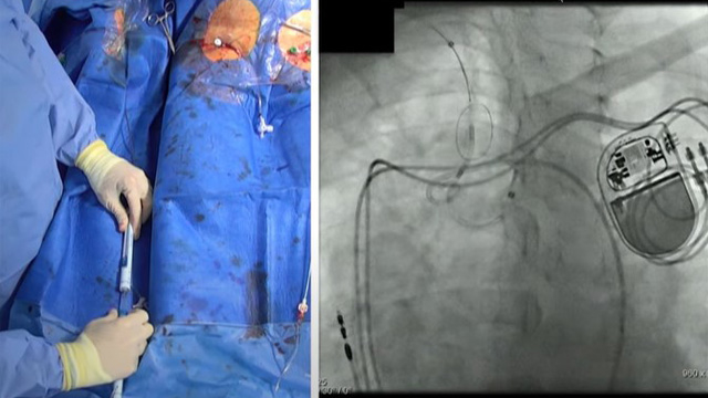 Cerebral embolic protection during TAVI: evidence meets practice