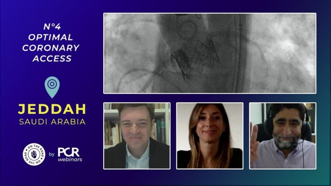 A patient undergoing TAVI- how should we achieve optimal coronary access?