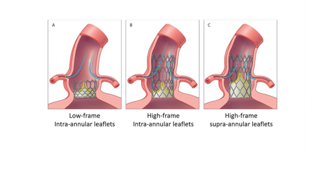 TAVI in bicuspid aortic valve disease