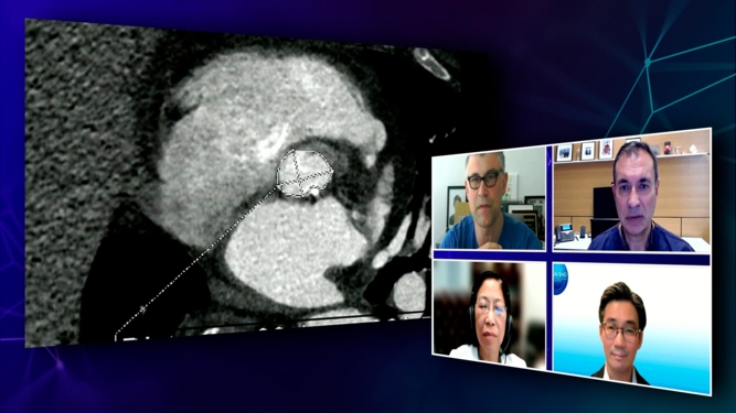 TAVI for today and tomorrow- What matters the most to patients?