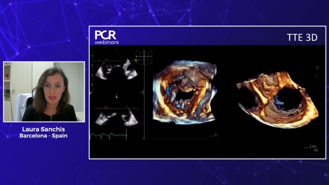 Echocardiographic imaging for transcatheter tricuspid intervention